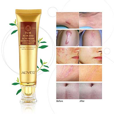 Scar Removal Cream For Old Scars by Cutie Academy
